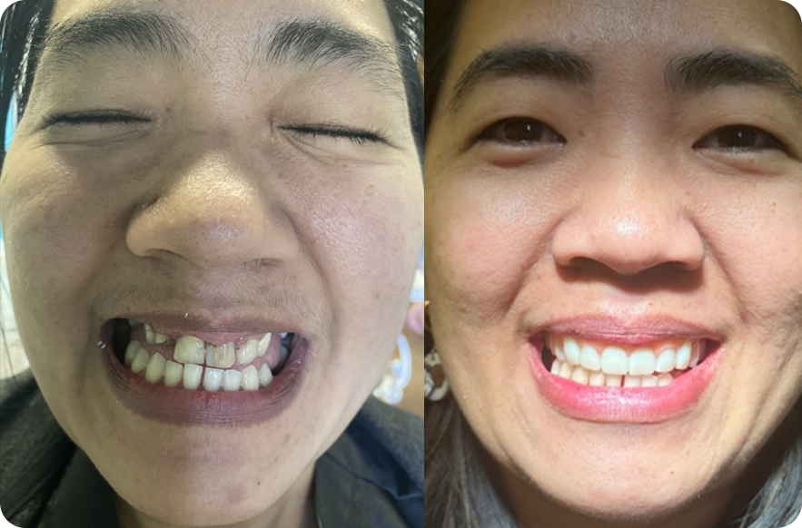 Quality Dental Implants in Albuquerque Quality Dental Implants at Budget-Friendly Prices in Albuquerque