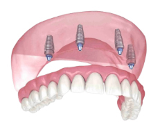 Dental Implants in Albuquerque NM Dental Implants in Albuquerque