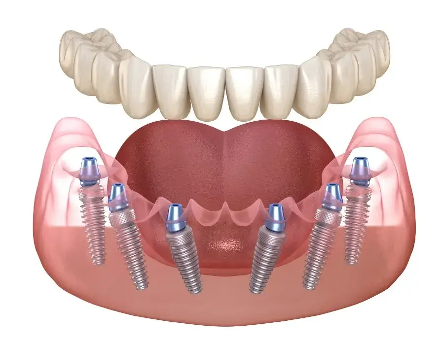 Dental Implants in Albuquerque, NM | Sandia Smiles Dental Implants in Albuquerque, NM
