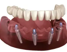 Find the Best Dental Implant Solution for Your Smile in Albuquerque