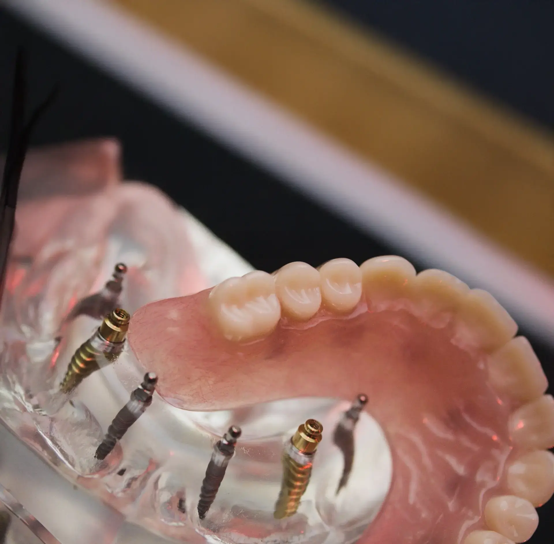 dental implant process in new mexico dental implant process in new mexico